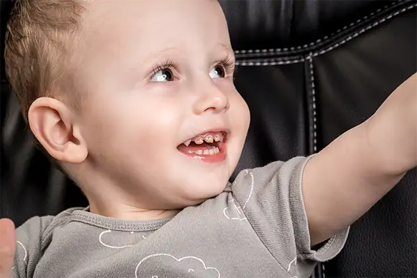 Smiling toddler with visible early cavities on front teeth, highlighting the importance of dental care for kids.