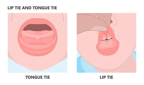 A side-by-side comparison of a tongue tie and a lip tie that will both need medical attention.