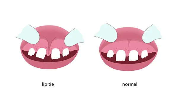 A comparison between a tongue tie and a lip tie in infants, highlighting the anatomical differences that may require a frenectomy procedure.