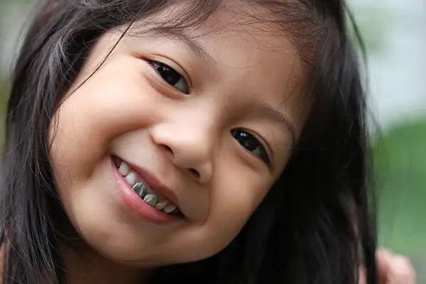A young girl smiling brightly, showing a metal dental crown on her molar that was placed during a pediatric dental treatment.