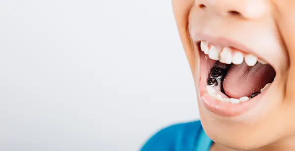 A close-up of a child opening their mouth, showing a metal dental crown on a molar they received during a pediatric dental restoration.